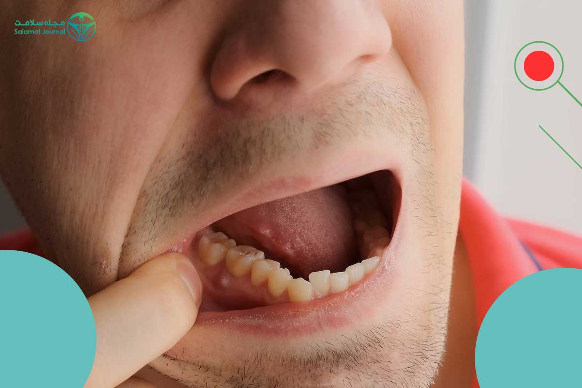 پیشگیری از عفونت دندان
