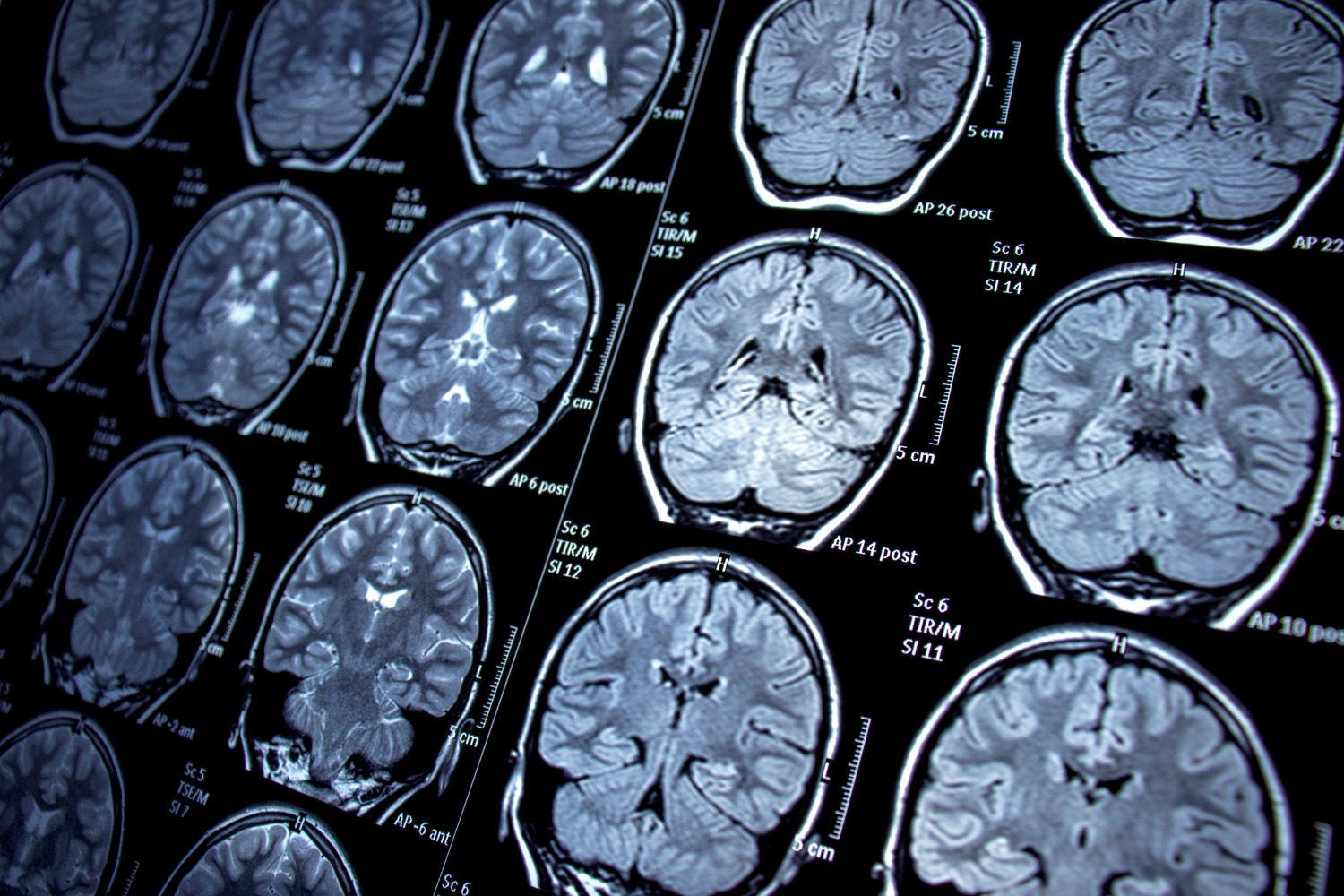 Procedures related to MRI reading