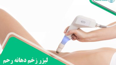 لیزر زخم دهانه رحم
