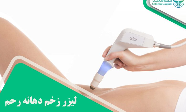 لیزر زخم دهانه رحم