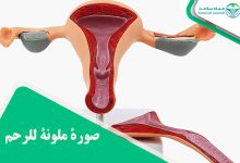 صورة ملونة للرحم