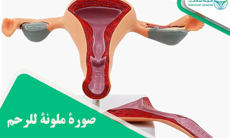 صورة ملونة للرحم